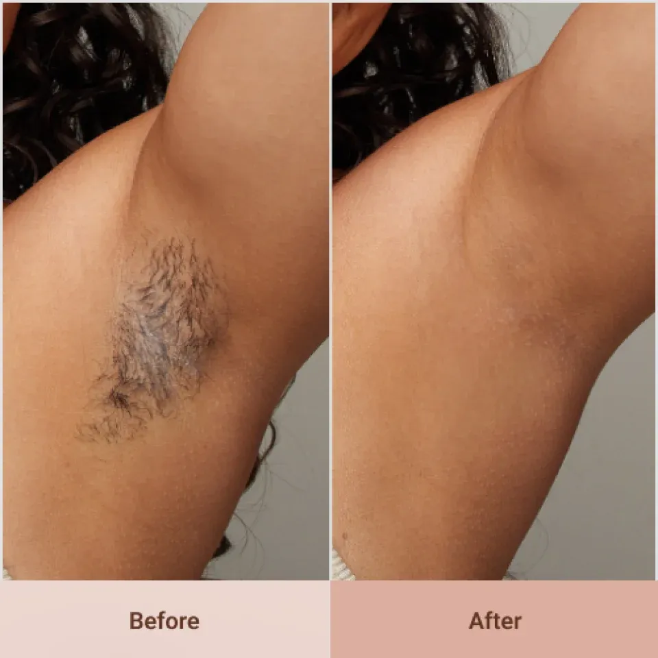 Before and after results with the LoweSkin epilator